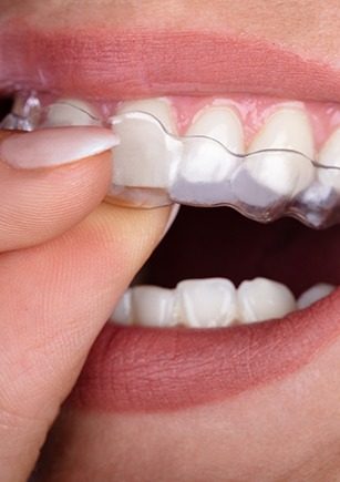 Clear Aligners | Calgary Dentist | Monarch Landing Dental | Calgary, AB